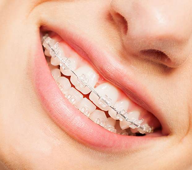 San Juan Capistrano Clear Braces