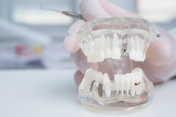 Implant Supported Dentures San Juan Capistrano, CA