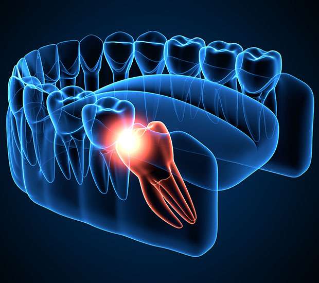 San Juan Capistrano Wisdom Teeth Extraction