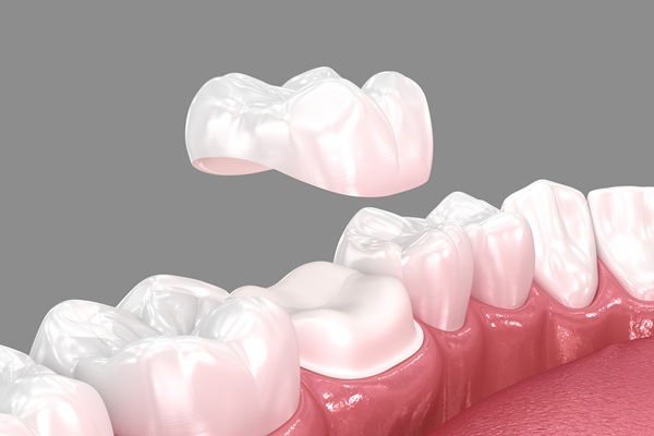 Common Issues With Dental Crowns And How To Fix Them