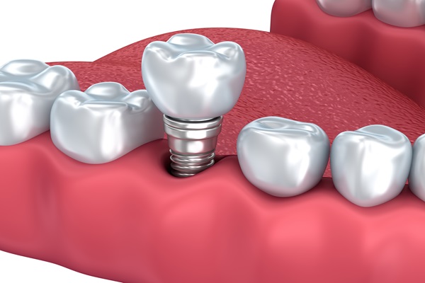 Dental Implants To Replace Missing Teeth